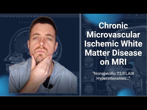 Understanding White Matter Disease: Causes, Symptoms, Treatment
