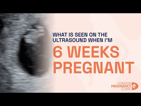 When Will You First Hear Your Baby's Heartbeat?