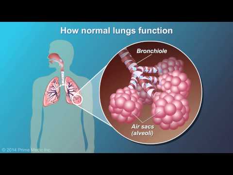 Understanding Chronic Lung Diseases: Causes and Risk Factors