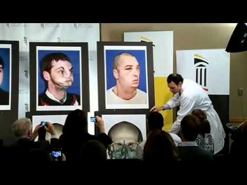 Face Transplants: A Remarkable Journey to Renewal