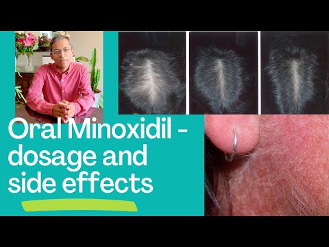 Minoxidil Insights: Uses, Dosage, and Side Effects Explained post thumbnail image