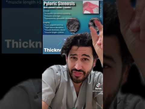 Understanding Pyloric Stenosis: Signs and Solutions post thumbnail image