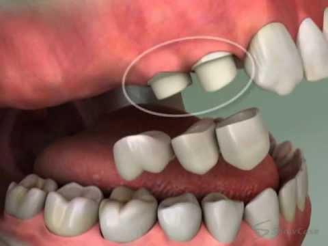 Cantilever Dental Bridge: What You Should Know for Oral Health