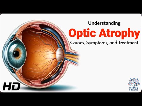 Understanding Optic Nerve Hypoplasia: Signs and Care Options