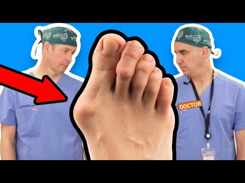 6 Key Symptoms That Indicate You Have Bunions