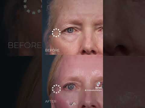 Transform Your Skin with CO2 Laser Resurfacing Insights