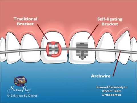 Self-Ligating Braces: Benefits, Costs, and Key Differences