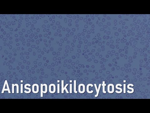 Understanding Anisopoikilocytosis: Causes and Treatment Options