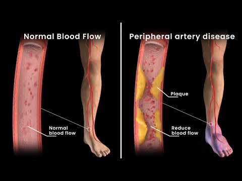 Understanding Angioplasty and Stents for Peripheral Artery Disease