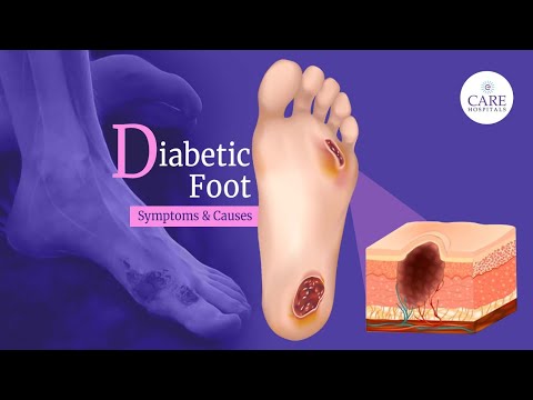 Caring for Diabetic Feet: Symptoms, Treatments, and Solutions