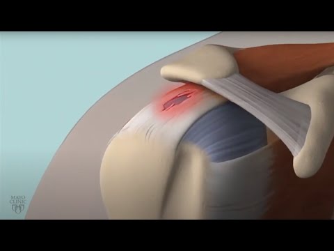 Understanding Rotator Cuff Tendinitis: Symptoms and Care