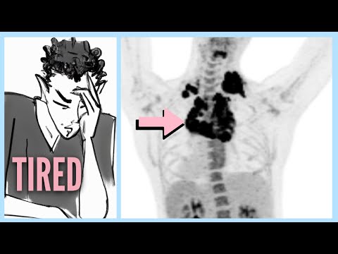 Recognizing the Key Lymphoma Symptoms You Shouldn't Ignore