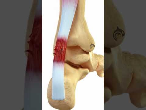 Understanding Achilles Tendon Rupture: Tests, Diagnosis, Care