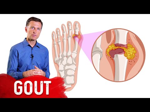 Effective Home Remedies for Gout Relief