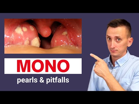 Mono Treatment: Effective Ways to Manage Mononucleosis
