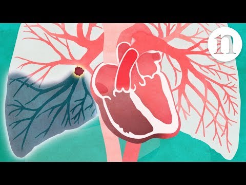 Recognizing Saddle Pulmonary Embolism: Symptoms and Care