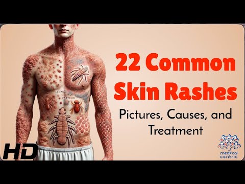 22 Skin Rashes: Causes, Pictures, and Treatments Explained
