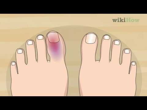 Healing a Broken Toe: Symptoms and Recovery Insights