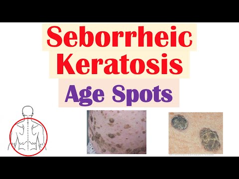 Distinguishing Seborrheic Keratosis From Melanoma: Key Facts