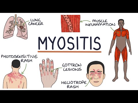 Understanding Polymyositis: Symptoms, Causes, and Treatment Options