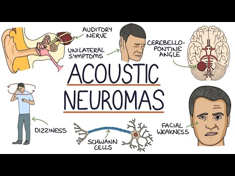Understanding Acoustic Neuroma: Symptoms and Treatment Options