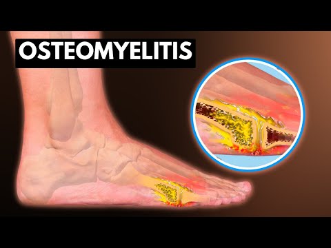 Osteomyelitis: Spotting Symptoms and Understanding Treatment post thumbnail image