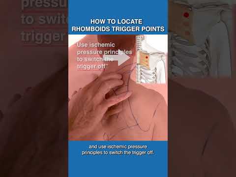 Understanding Trigger Points in Physical Therapy for Pain Relief post thumbnail image