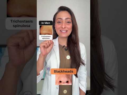 Effective Strategies for Treating Blackheads on the Nose