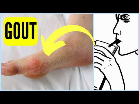 Understanding Gout: Signs and Symptoms in Your Foot post thumbnail image