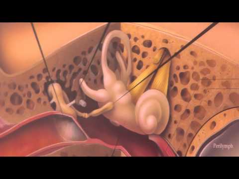 Cholesteatoma: Understanding Causes, Symptoms, and Diagnosis